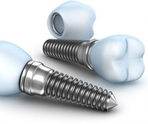 Implant dentist in Fall River