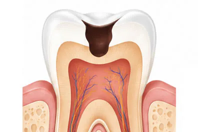 Tooth Colored Fillings